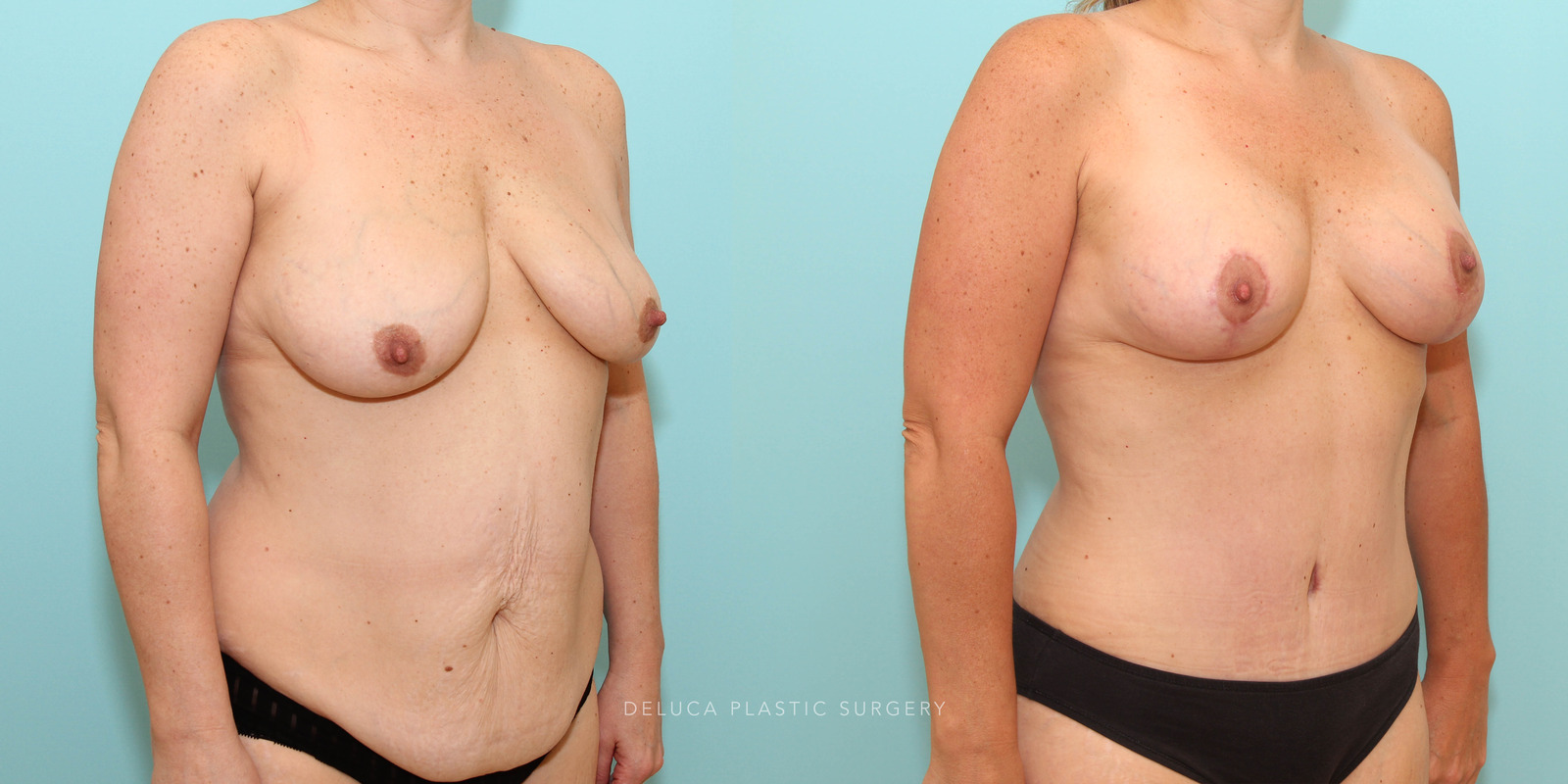 43 year old Mommy Makeover - Breast Lift and Augmentation and Abdominoplasty