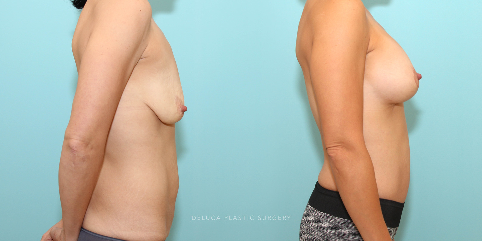 Mommy makeover in a young woman after pregnancy and 100lb weight loss