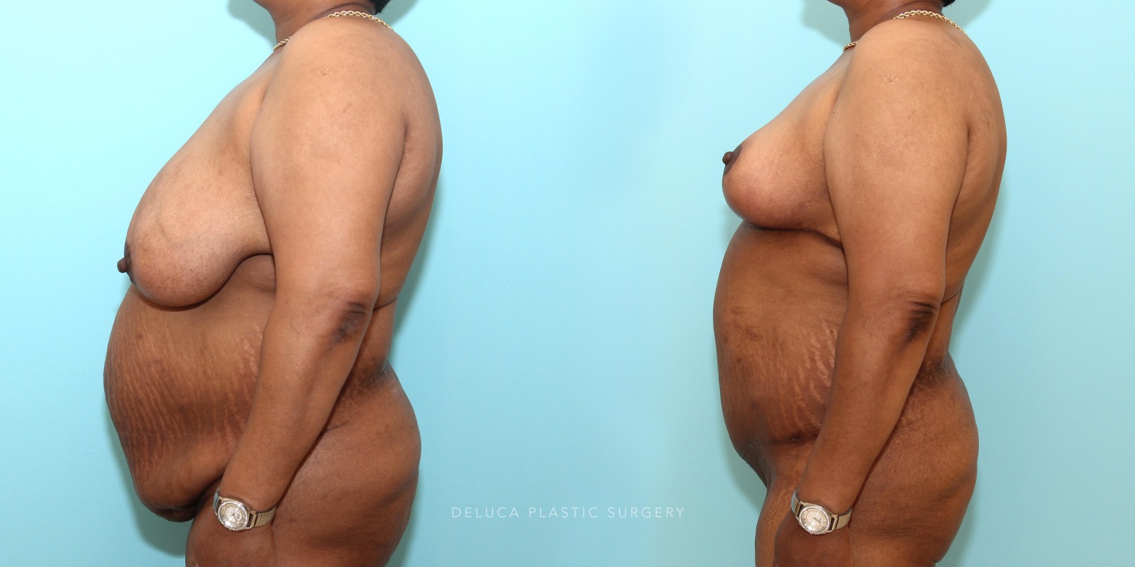 53 year old woman Mommy Makeover - Tummy Tuck (Abdominoplasty) and Inferior Pedicle, Wise Pattern Breast Reduction