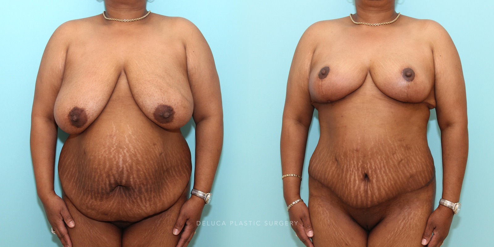 53 year old woman Mommy Makeover - Tummy Tuck (Abdominoplasty) and Inferior Pedicle, Wise Pattern Breast Reduction