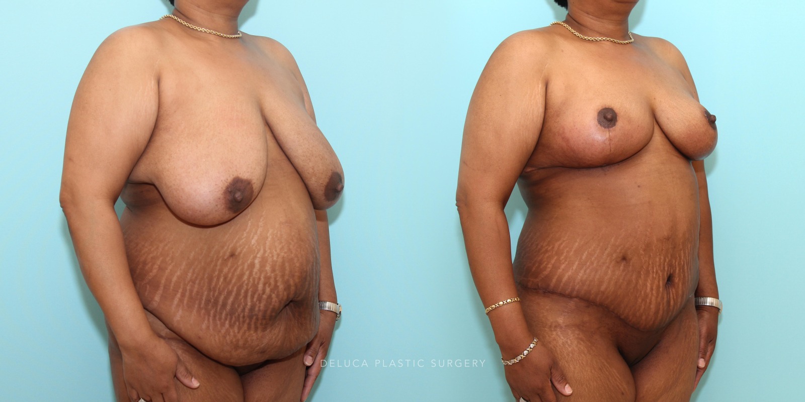 53 year old woman Mommy Makeover - Tummy Tuck (Abdominoplasty) and Inferior Pedicle, Wise Pattern Breast Reduction