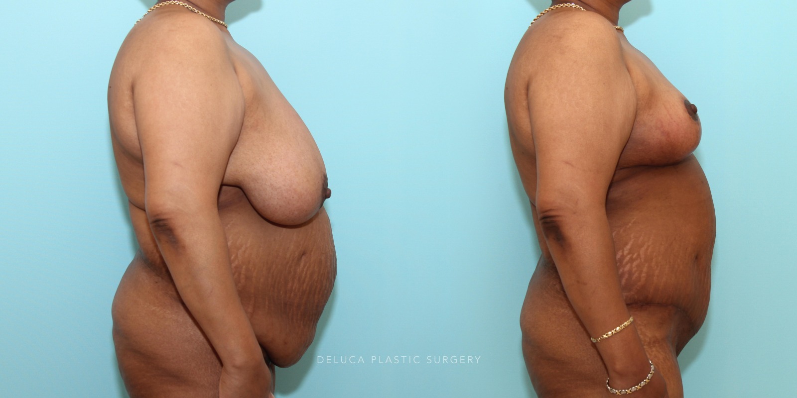 53 year old woman Mommy Makeover - Tummy Tuck (Abdominoplasty) and Inferior Pedicle, Wise Pattern Breast Reduction