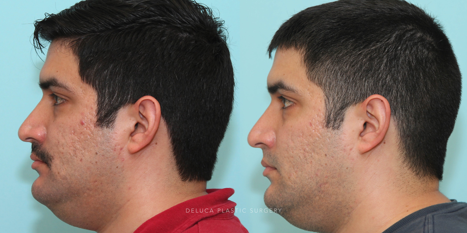 29 year old Otoplasty