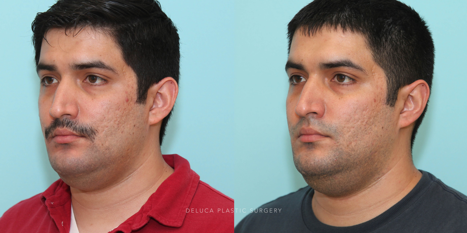 29 year old Otoplasty