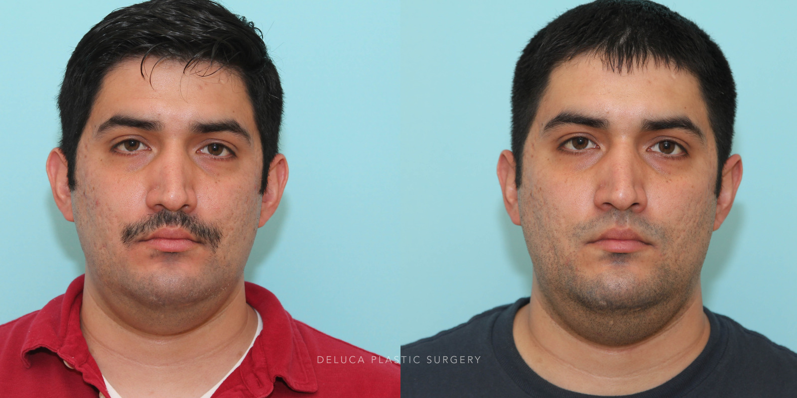 29 year old Otoplasty