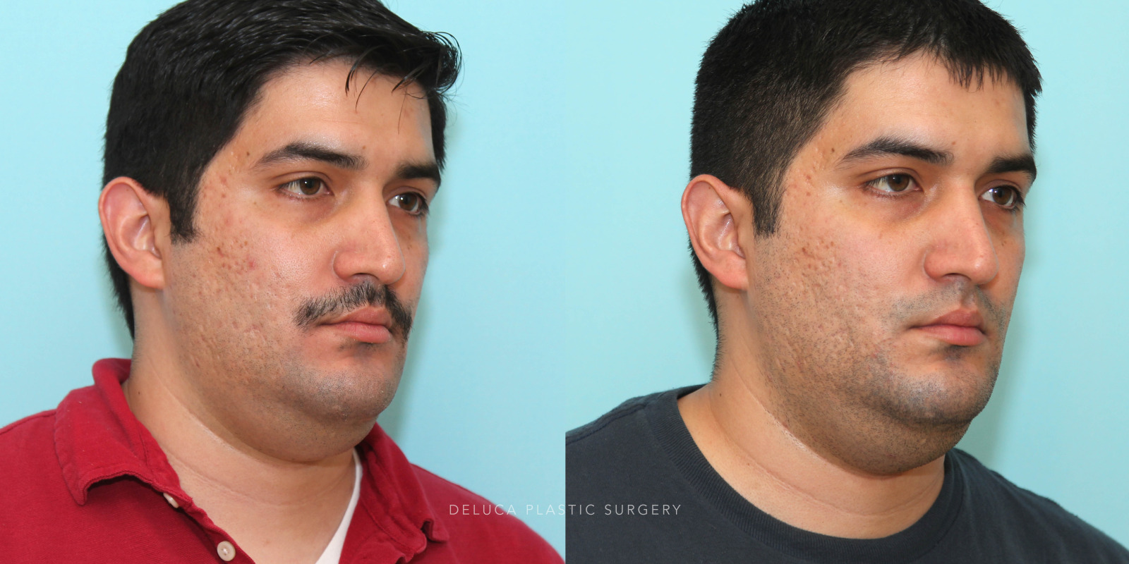 29 year old Otoplasty