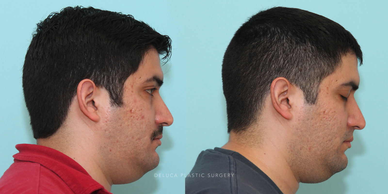 29 year old Otoplasty