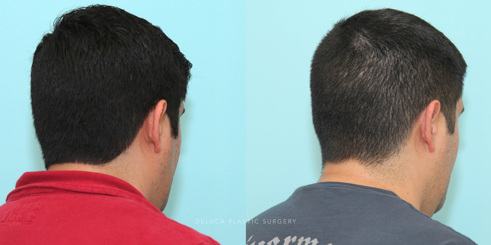 29 year old Otoplasty