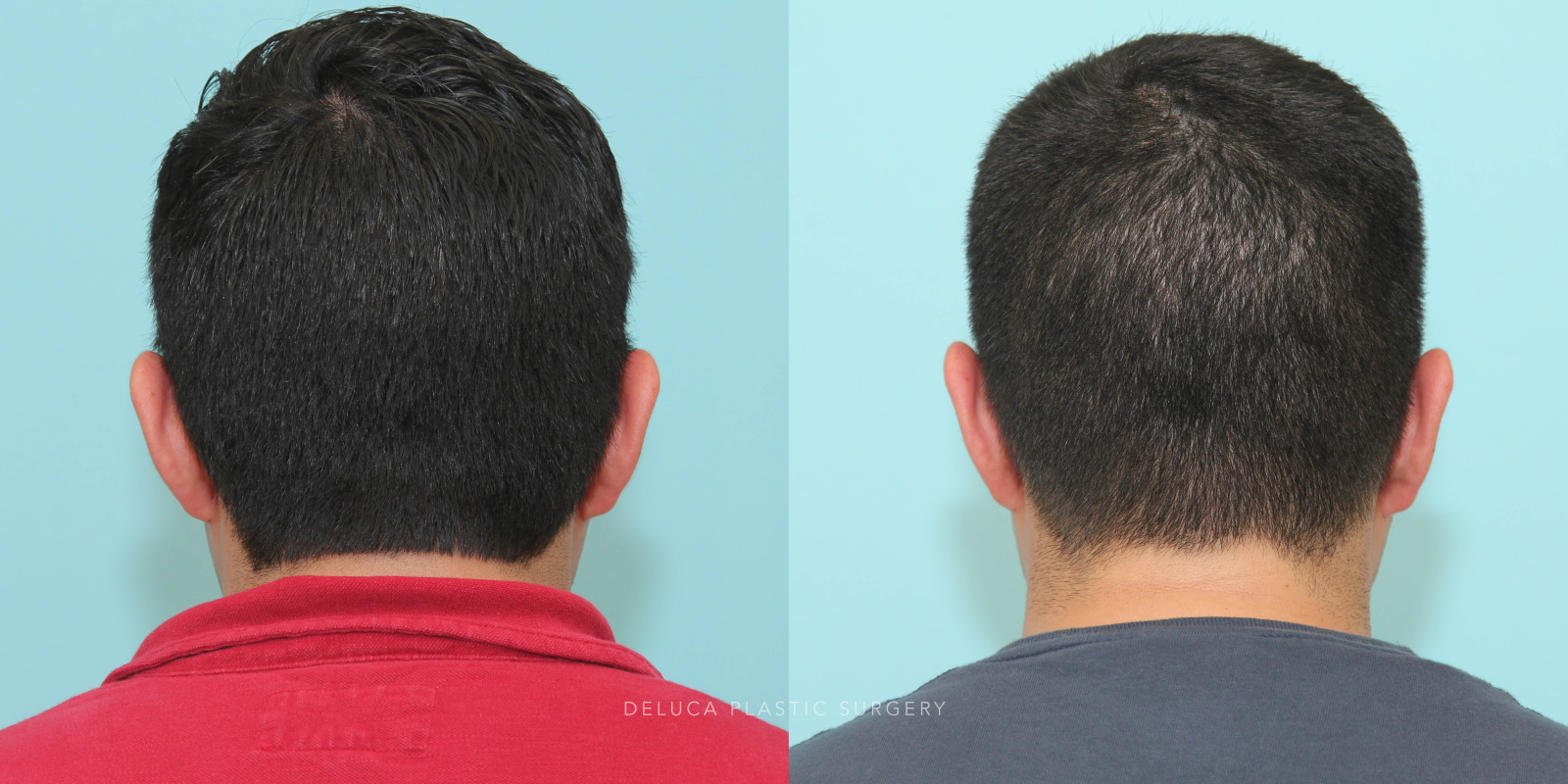 29 year old Otoplasty