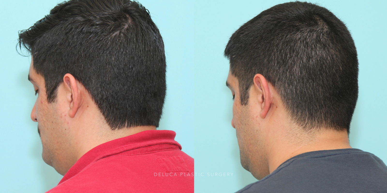 29 year old Otoplasty