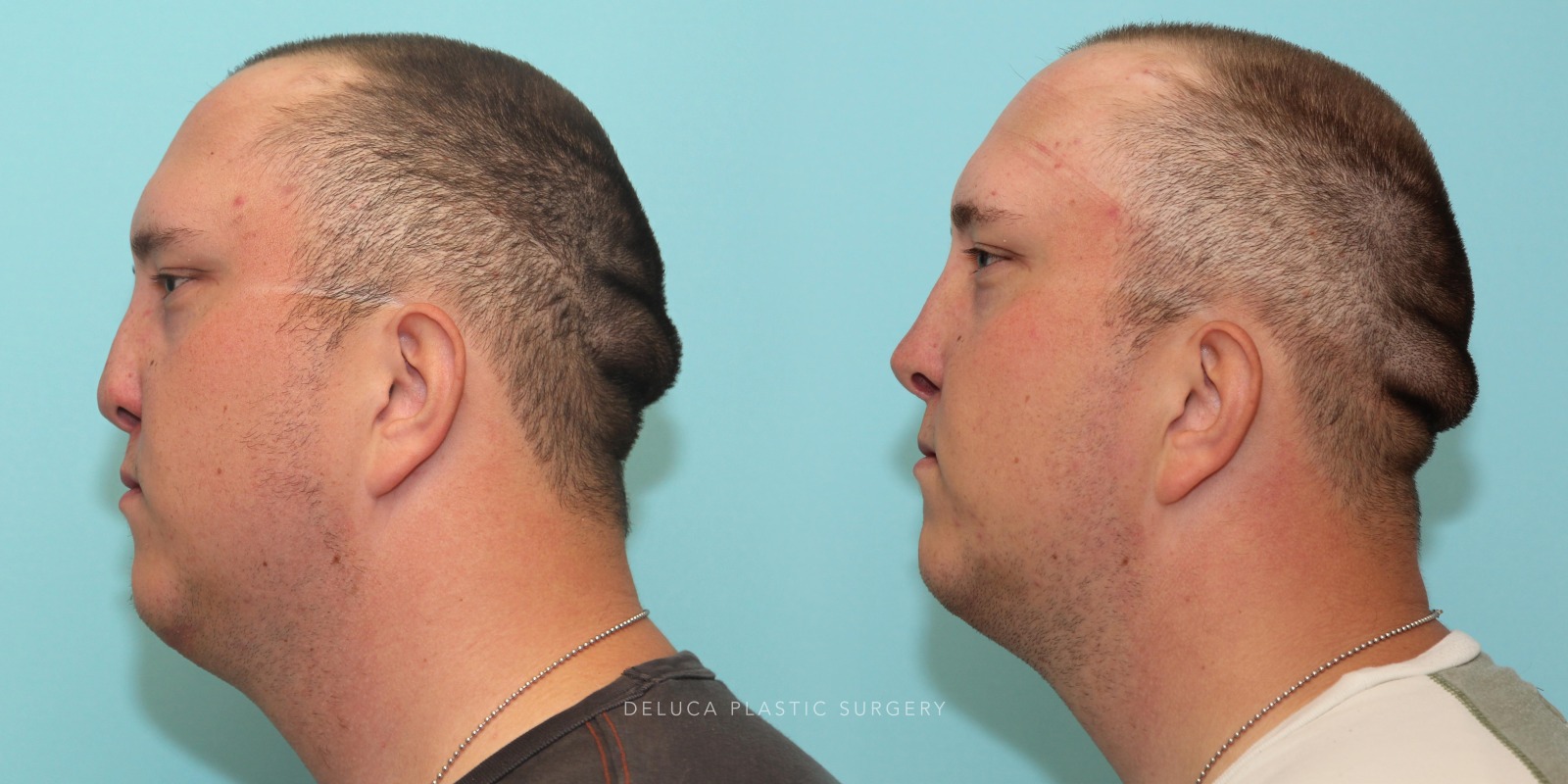 24 year old Reconstructive Rhinoplasty Using Rib Graft
