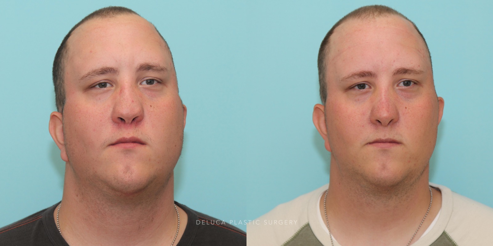 24 year old Reconstructive Rhinoplasty Using Rib Graft