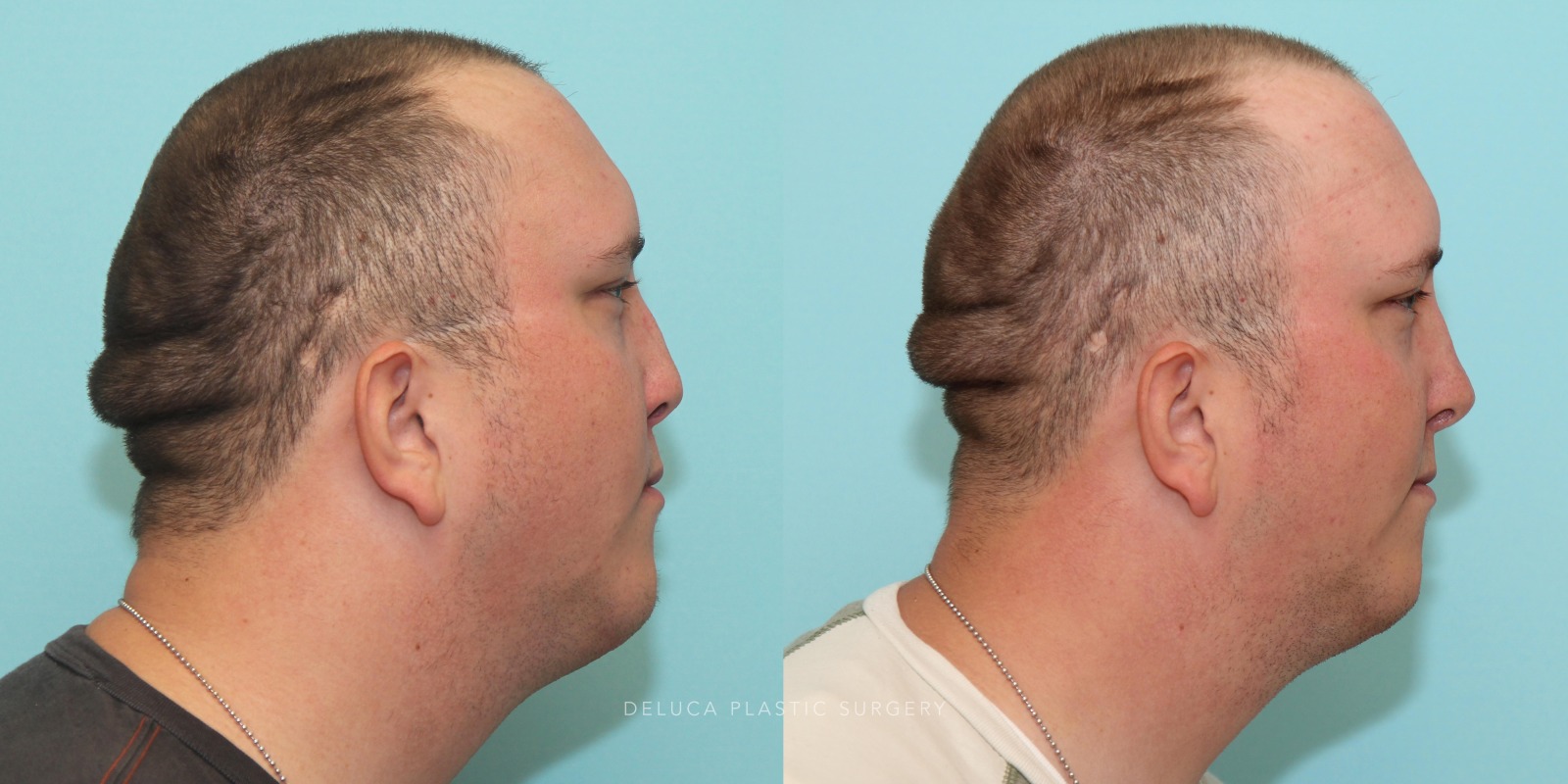 24 year old Reconstructive Rhinoplasty Using Rib Graft
