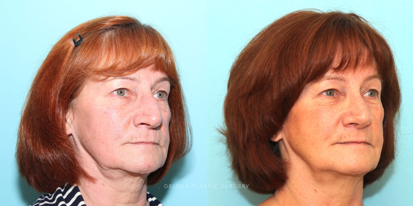 63 year old Septoplasty and Cosmetic Rhinoplasty