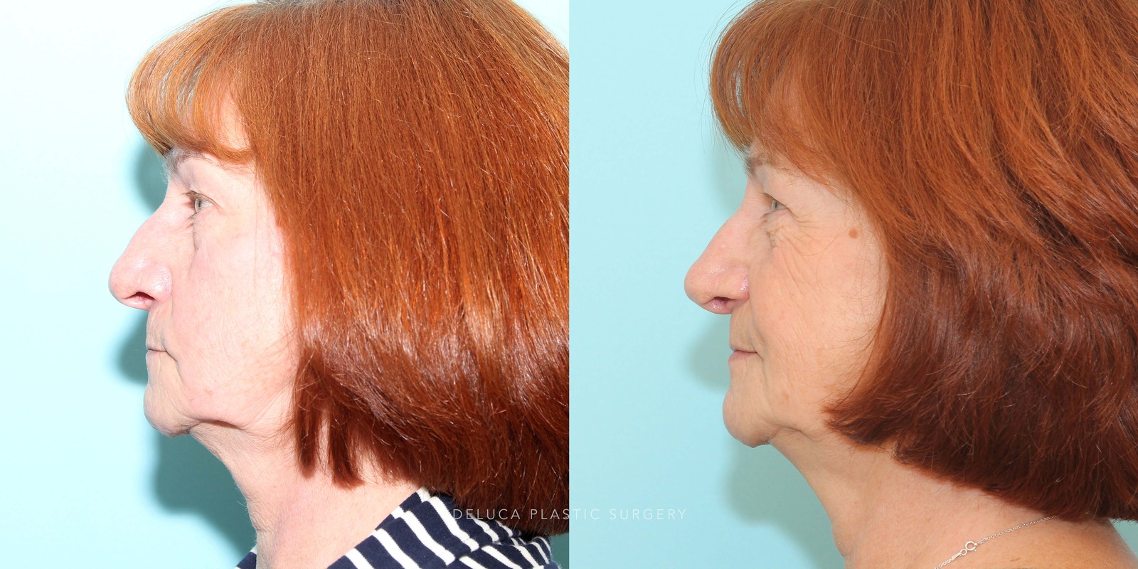 63 year old Septoplasty and Cosmetic Rhinoplasty