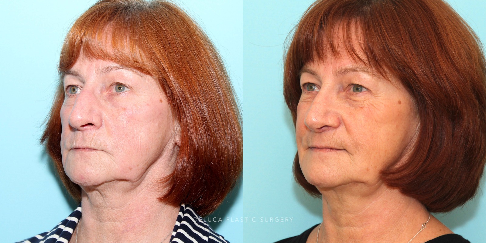 63 year old Septoplasty and Cosmetic Rhinoplasty