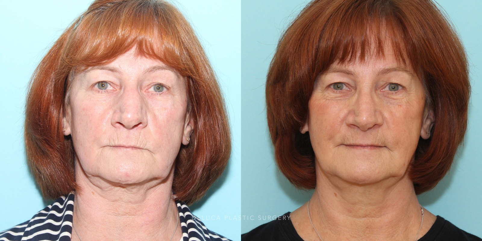 63 year old Septoplasty and Cosmetic Rhinoplasty