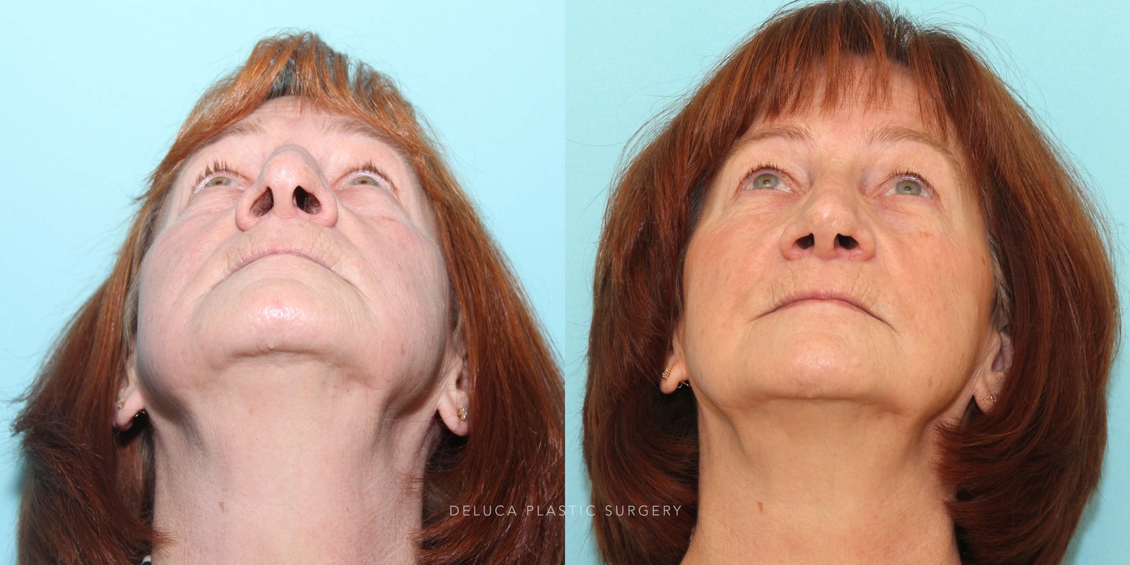 63 year old Septoplasty and Cosmetic Rhinoplasty