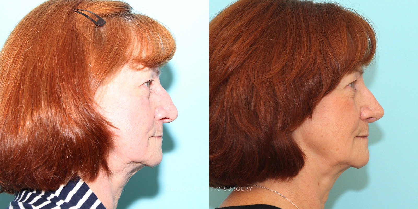 63 year old Septoplasty and Cosmetic Rhinoplasty