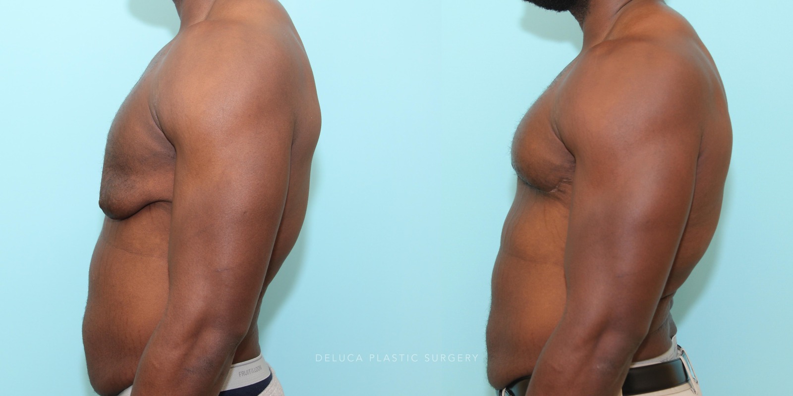 24 year old Correction of Gynecomastia Using Double Incision Free Nipple Graft
