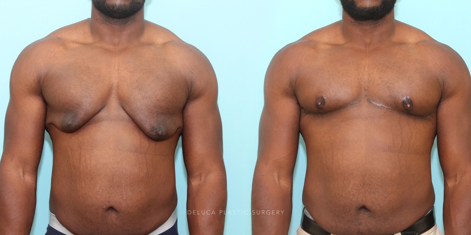 24 year old Correction of Gynecomastia Using Double Incision Free Nipple Graft