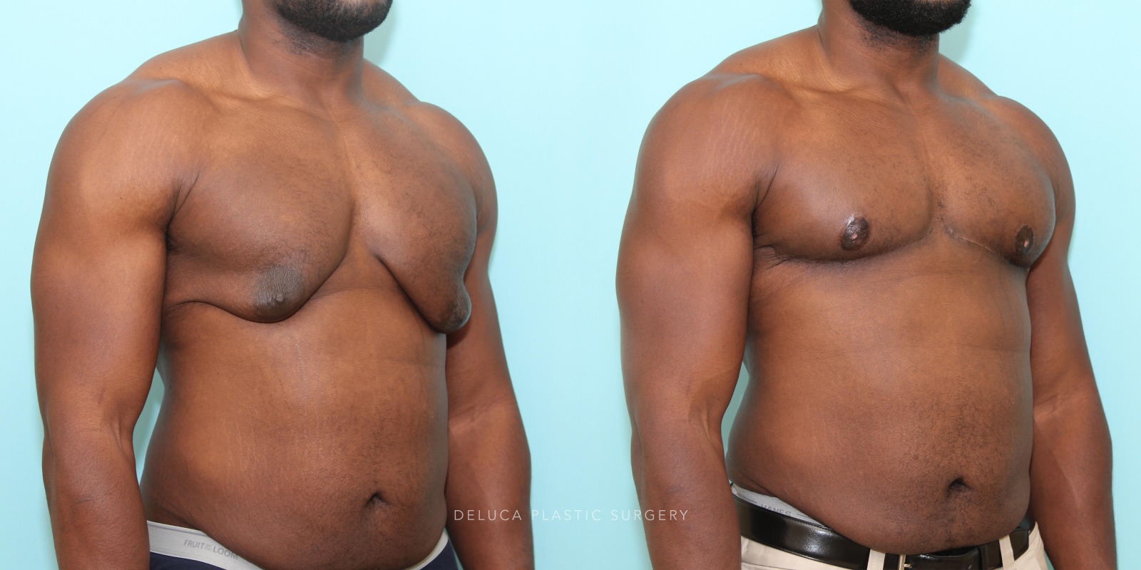 24 year old Correction of Gynecomastia Using Double Incision Free Nipple Graft