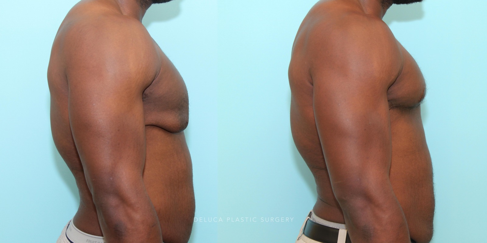 24 year old Correction of Gynecomastia Using Double Incision Free Nipple Graft