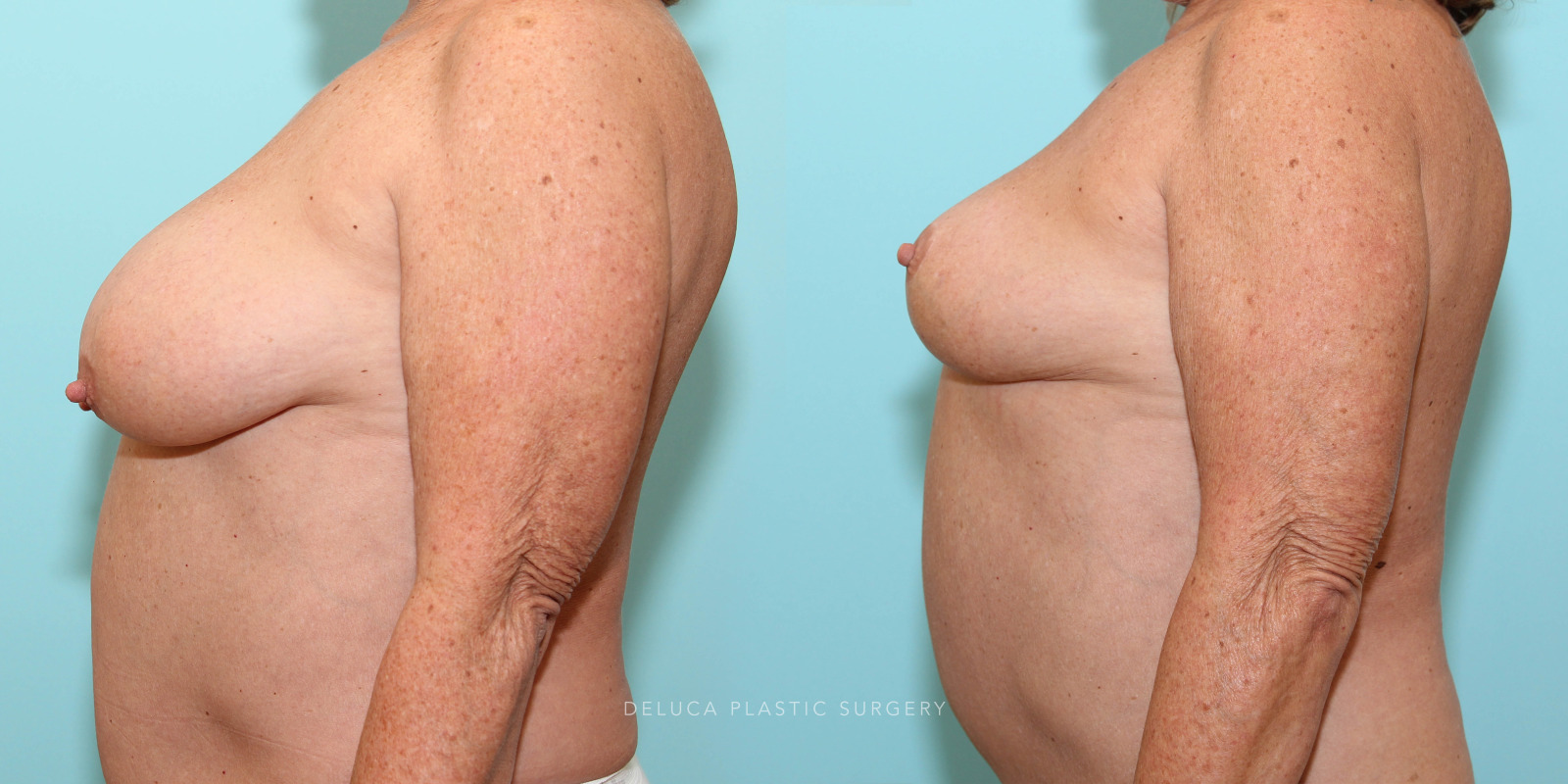 62 year old Superior Pedicle, Wise Pattern Breast Reduction