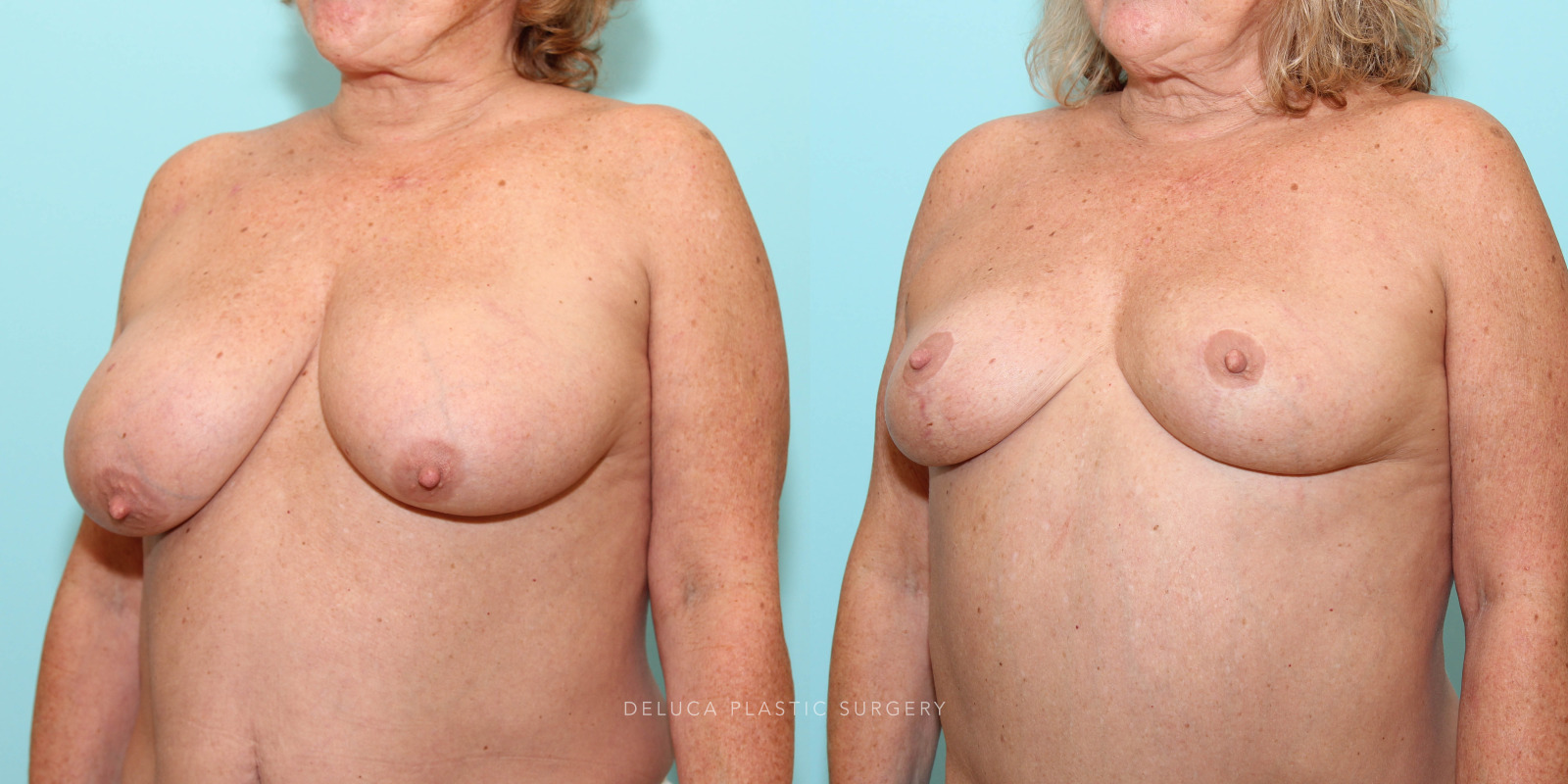 62 year old Superior Pedicle, Wise Pattern Breast Reduction