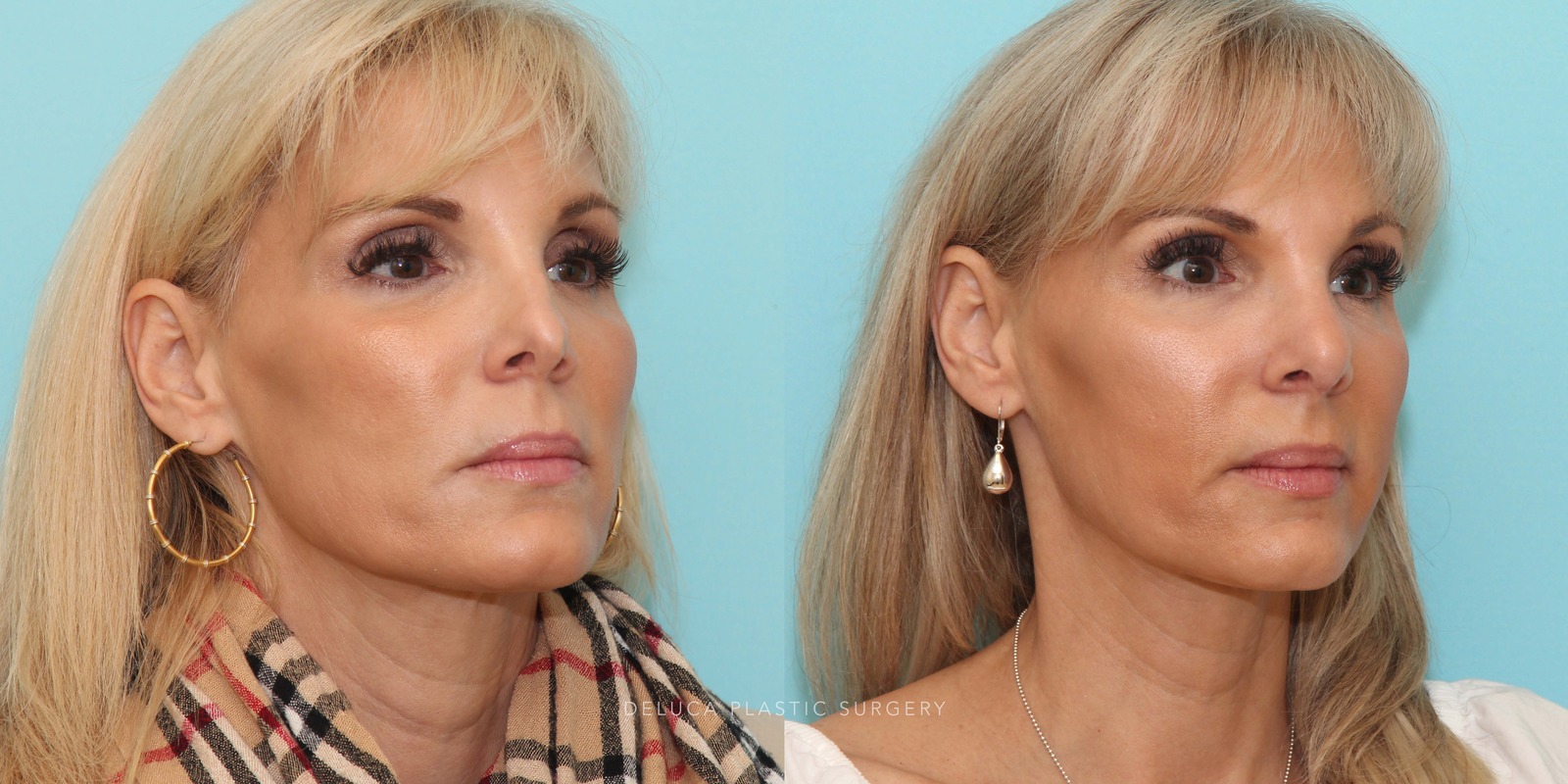 51 year old Revision Rhinoplasty Using Rib Grafting