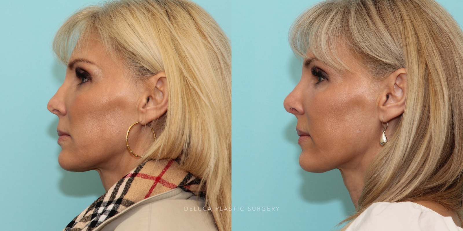51 year old Revision Rhinoplasty Using Rib Grafting