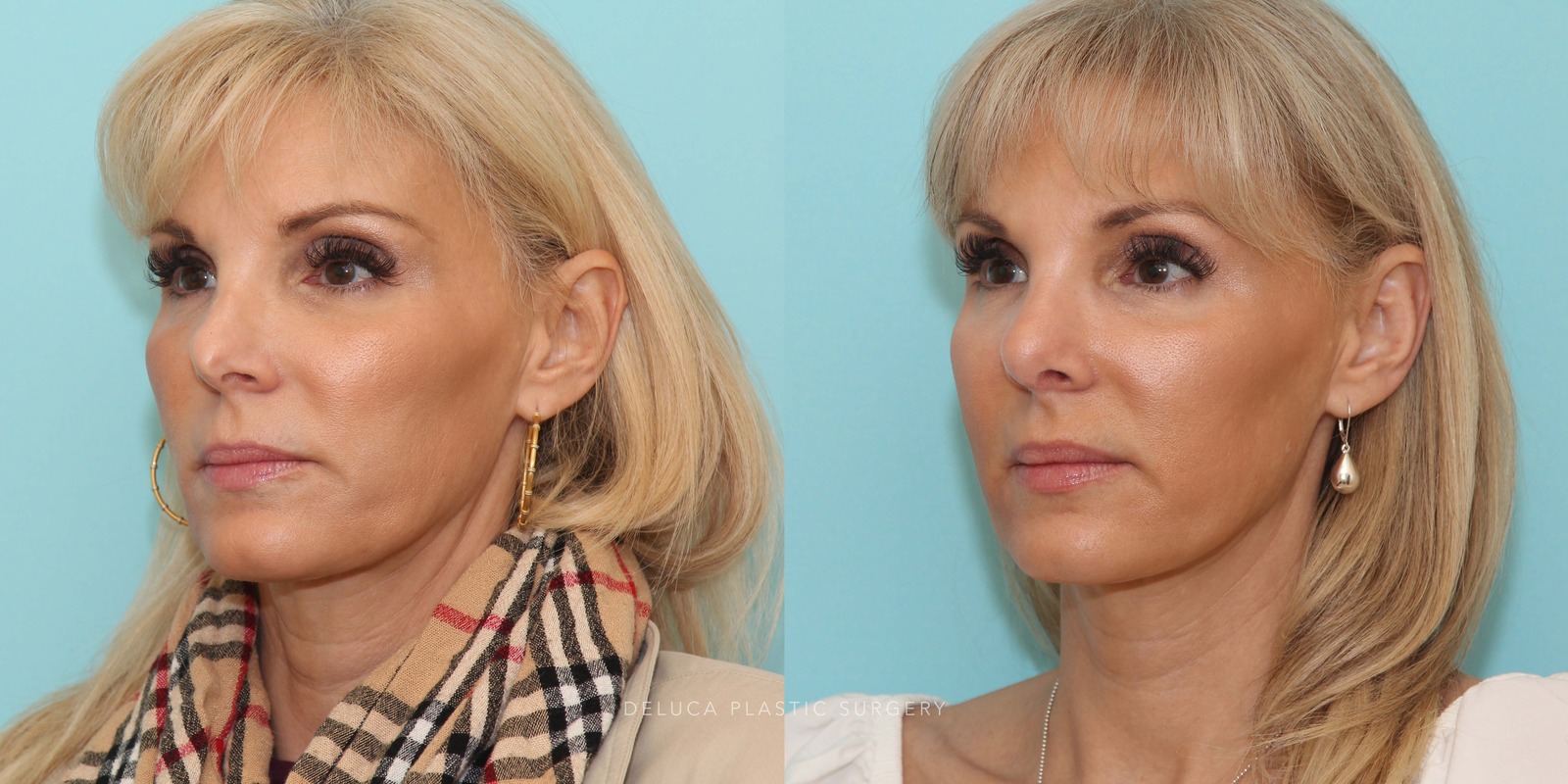 51 year old Revision Rhinoplasty Using Rib Grafting
