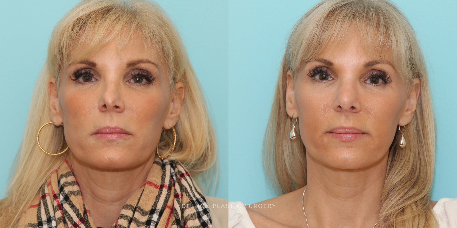 51 year old Revision Rhinoplasty Using Rib Grafting