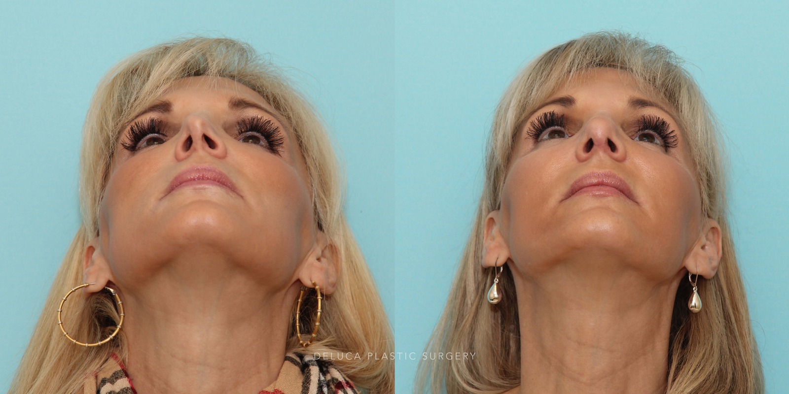 51 year old Revision Rhinoplasty Using Rib Grafting