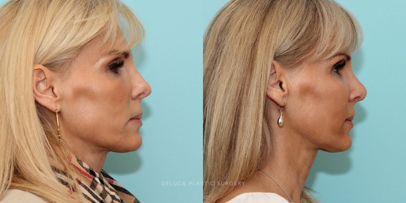 51 year old Revision Rhinoplasty Using Rib Grafting