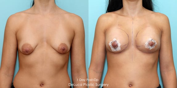 Tubular breast augmentation correction, before & after 1