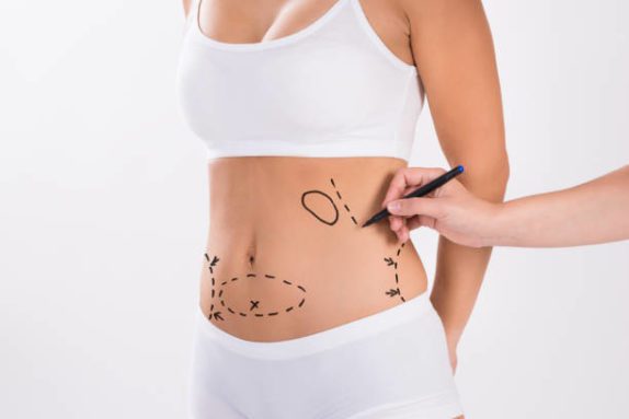 a female patient preparing for a tummy tuck procedure