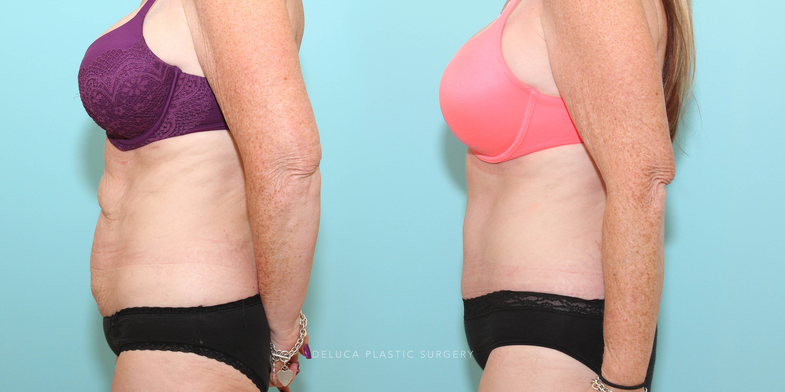 Tummy tuck in a 47 year old woman following significant weight loss