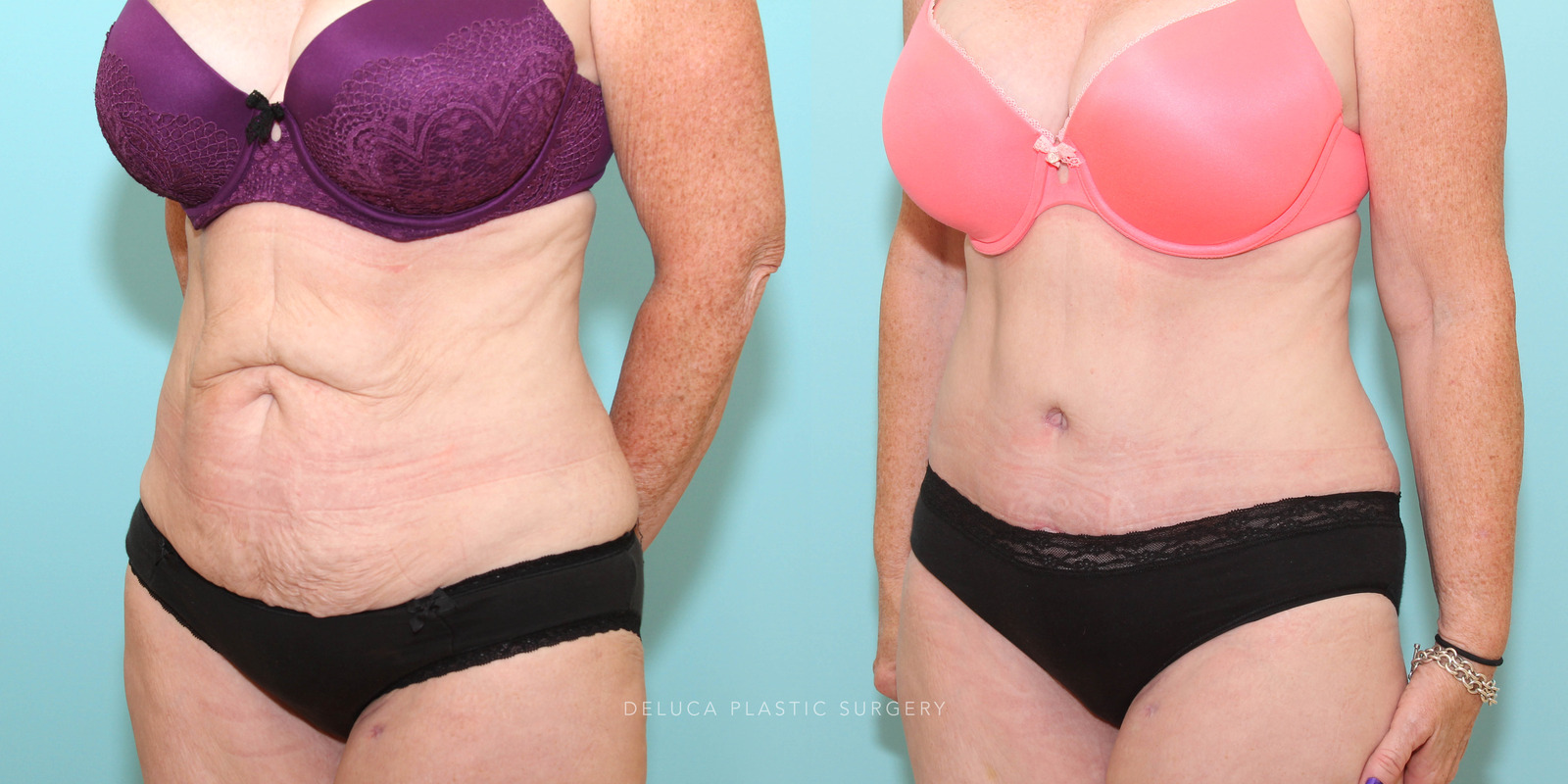 Tummy tuck in a 47 year old woman following significant weight loss