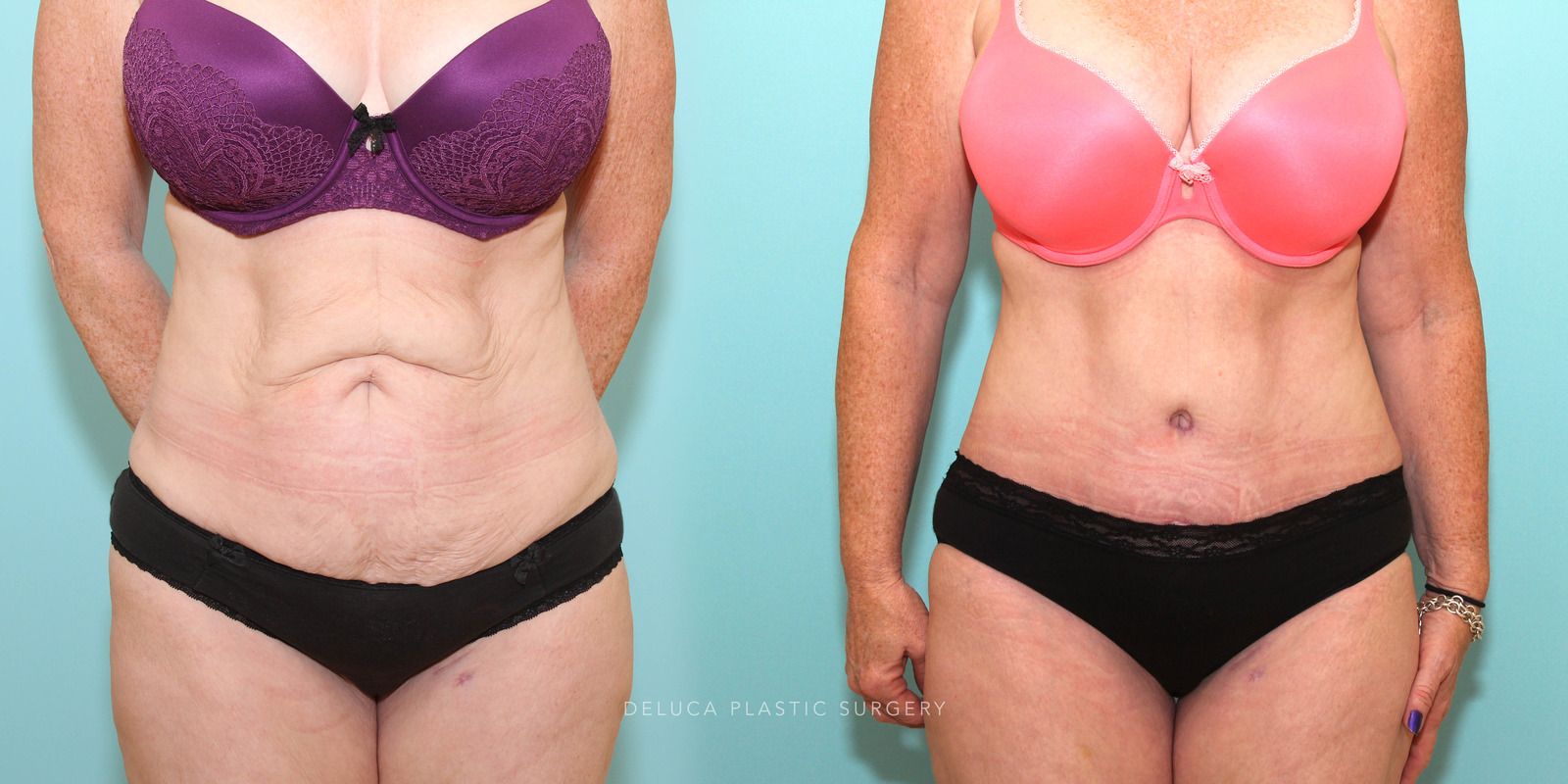Tummy tuck in a 47 year old woman following significant weight loss