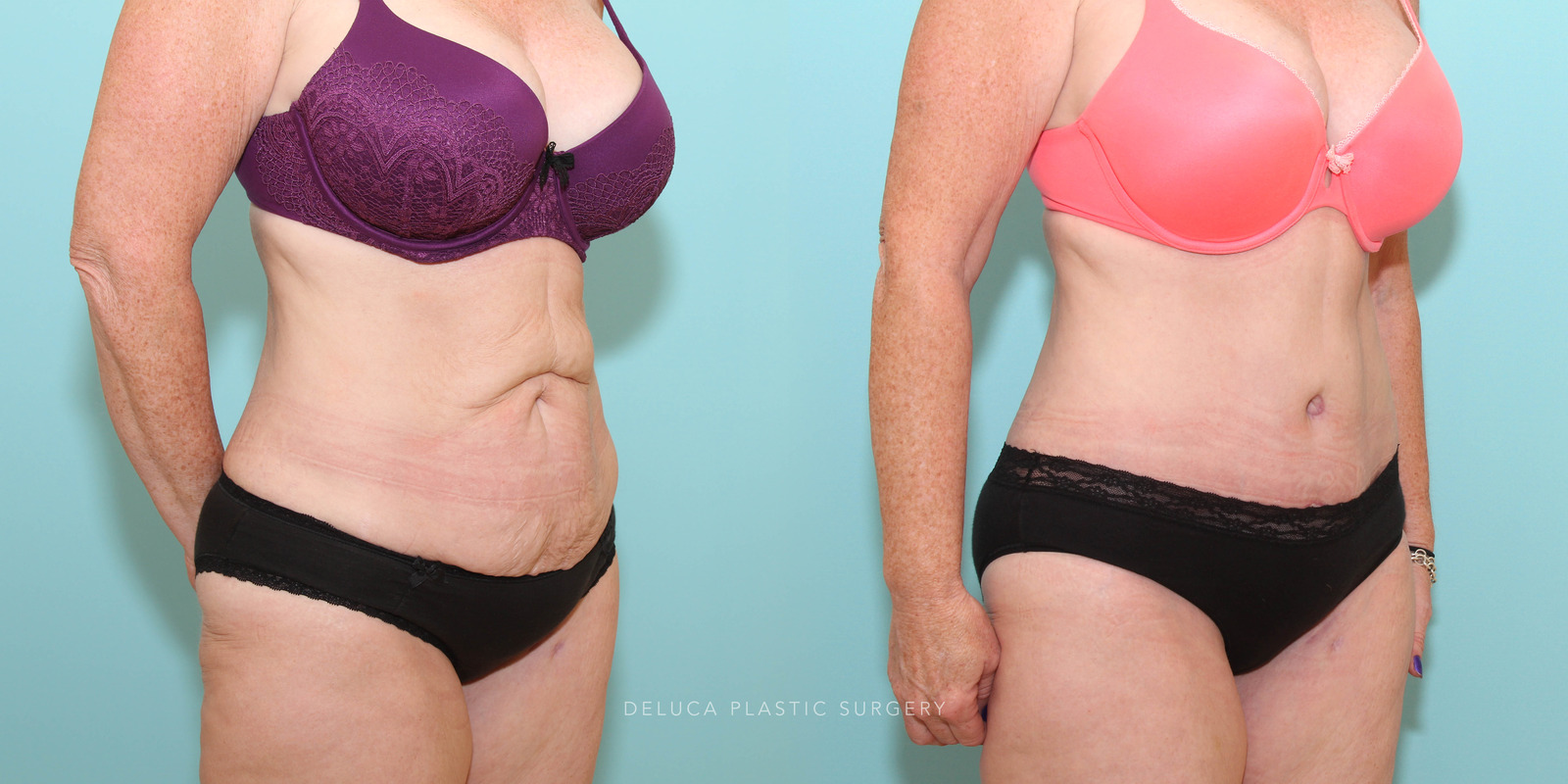 Tummy tuck in a 47 year old woman following significant weight loss