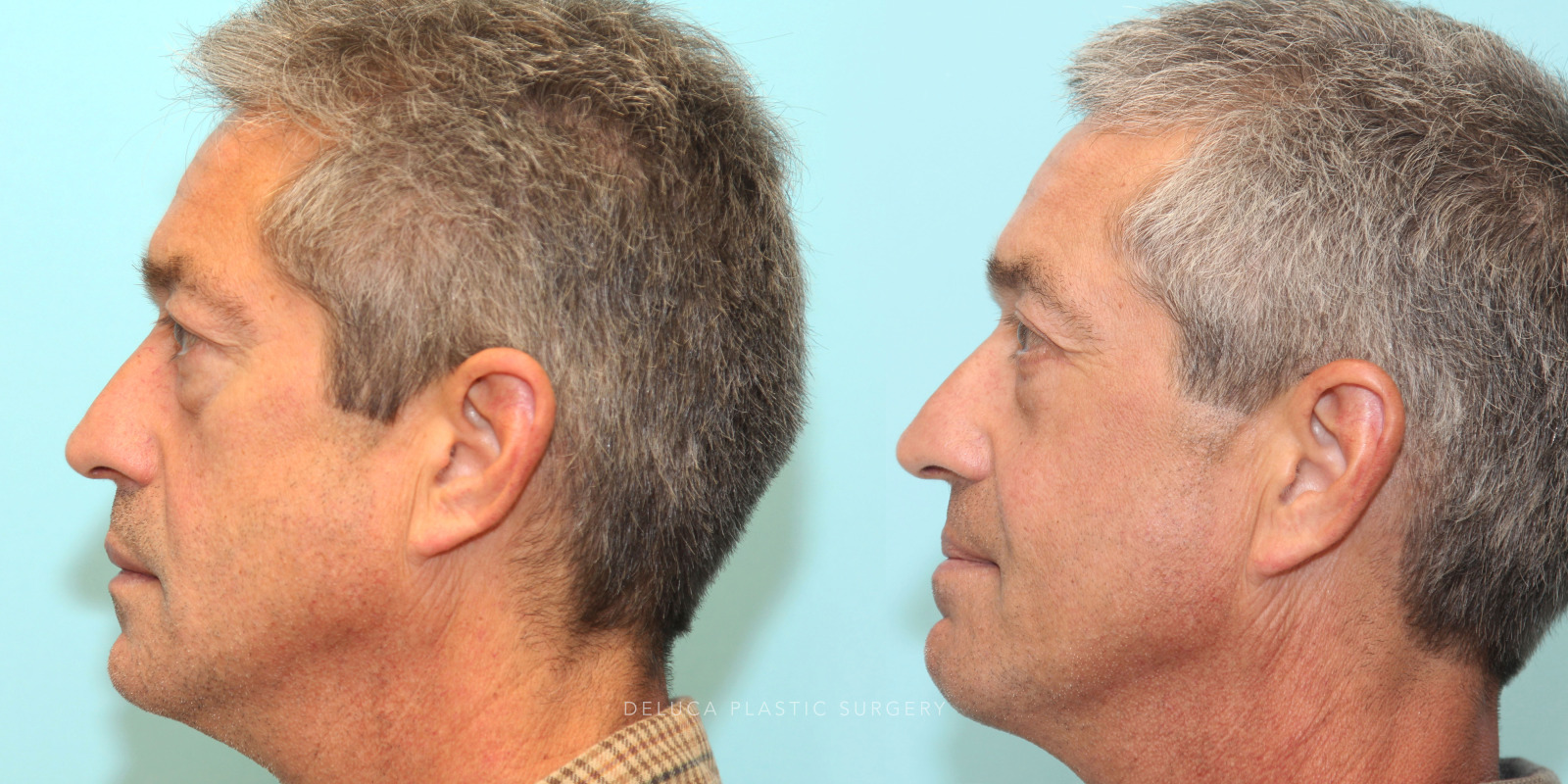 55 year old Upper and Lower Eyelid Blepharoplasty (Eyelid Lift) with Fat Redraping and Mid-face Implants