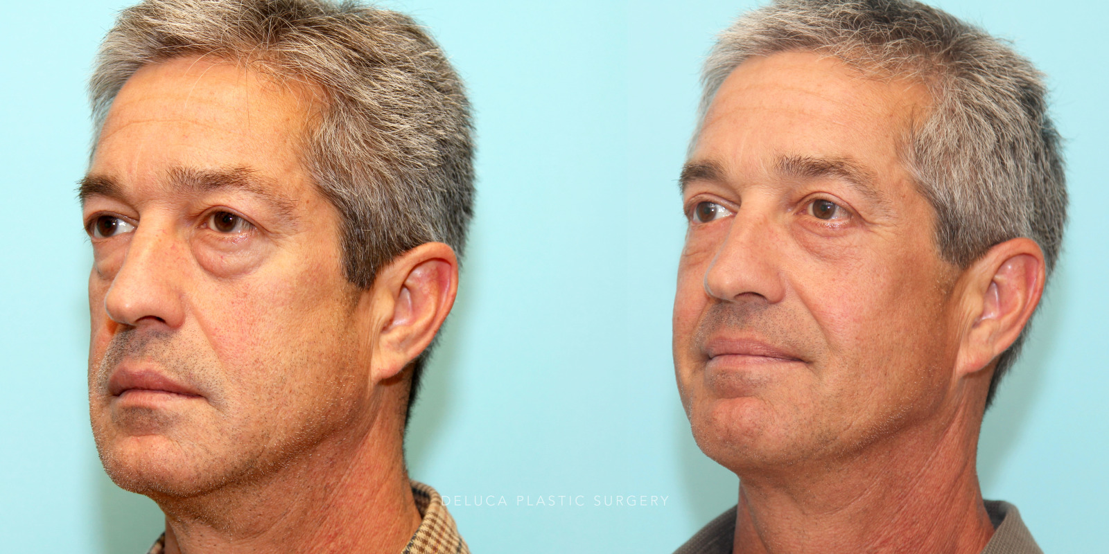 55 year old Upper and Lower Eyelid Blepharoplasty (Eyelid Lift) with Fat Redraping and Mid-face Implants