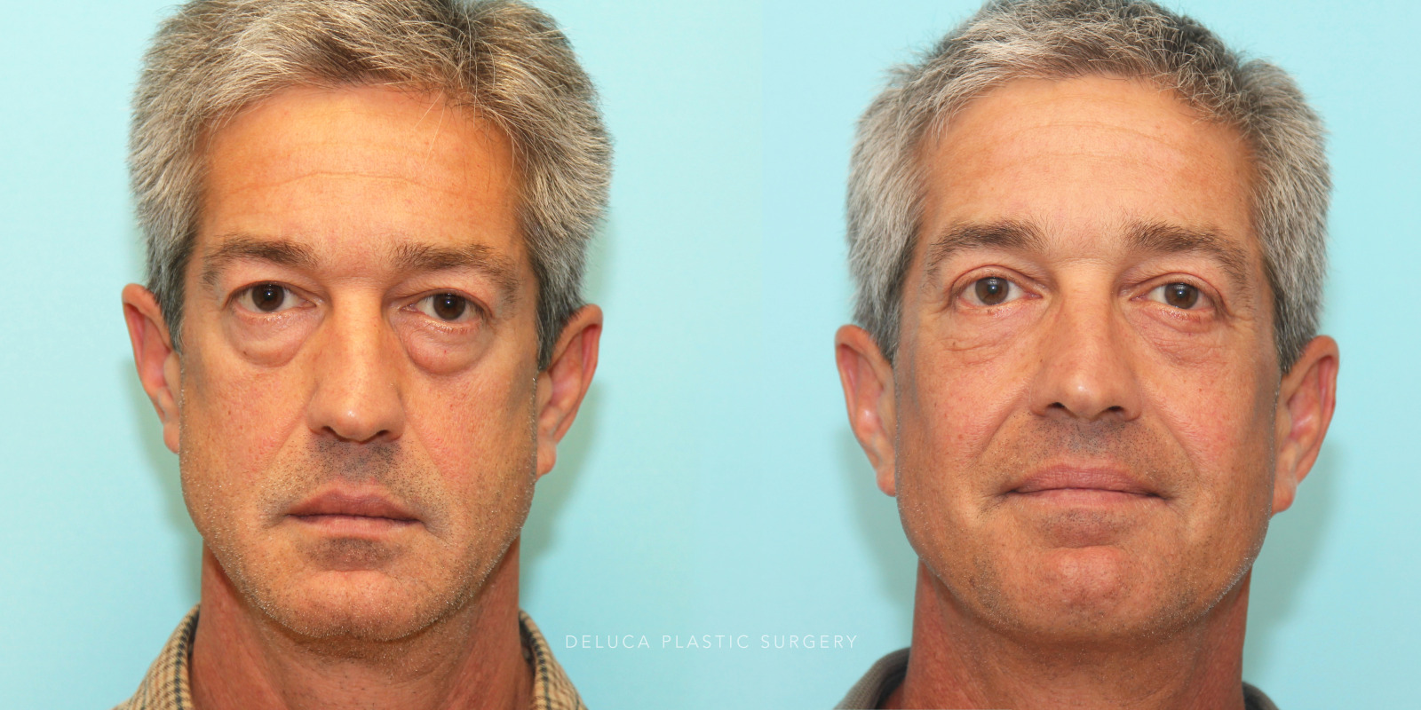 55 year old Upper and Lower Eyelid Blepharoplasty (Eyelid Lift) with Fat Redraping and Mid-face Implants