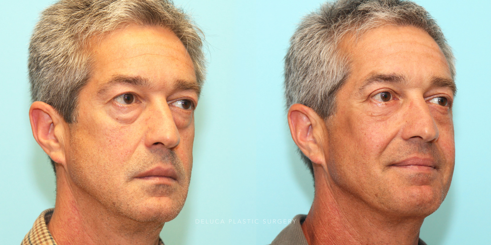 55 year old Upper and Lower Eyelid Blepharoplasty (Eyelid Lift) with Fat Redraping and Mid-face Implants
