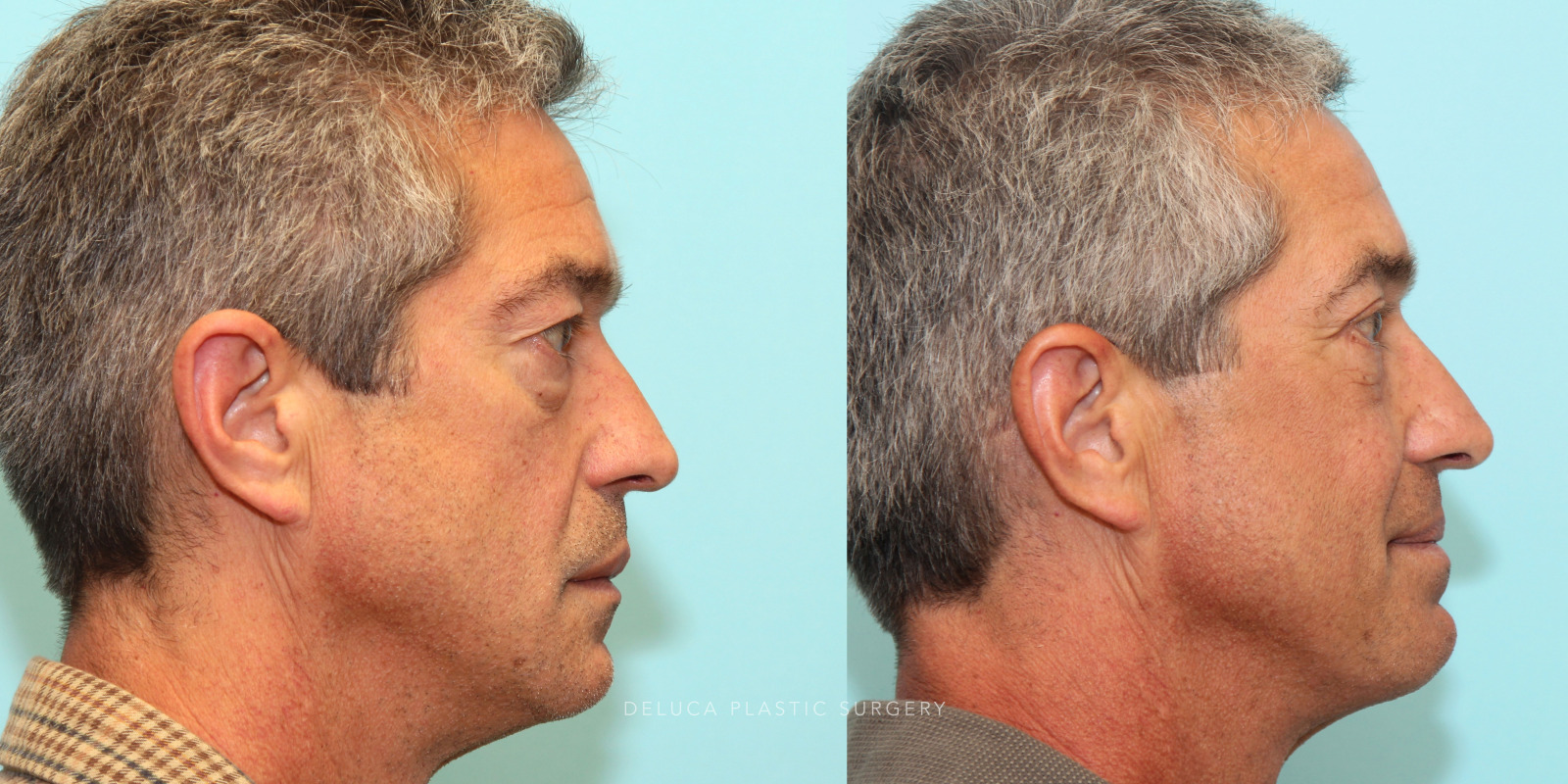 55 year old Upper and Lower Eyelid Blepharoplasty (Eyelid Lift) with Fat Redraping and Mid-face Implants