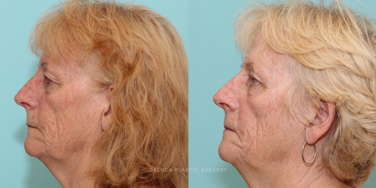 69 year old Upper Eyelid Blepharoplasty