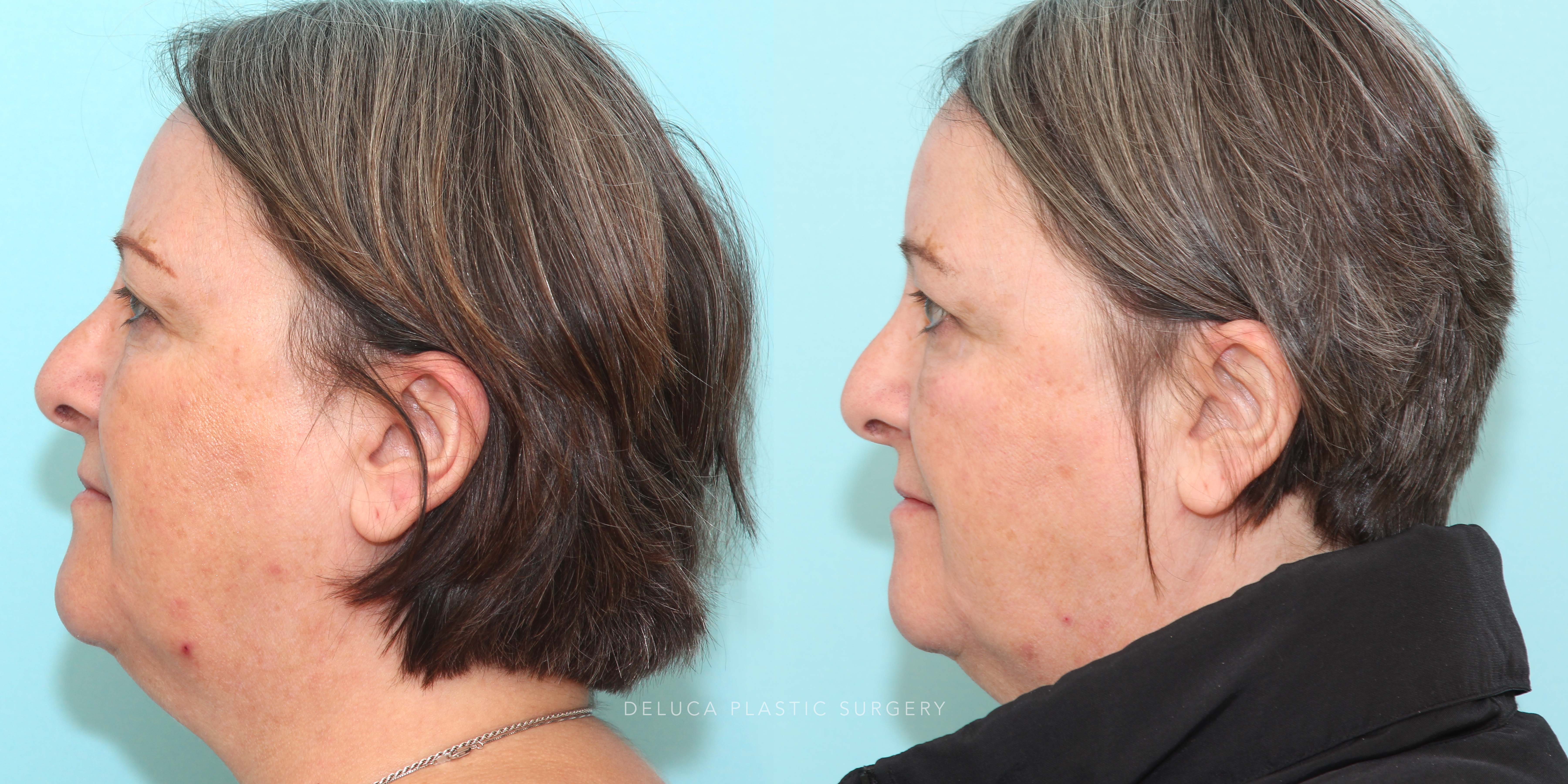 63 year old Upper Lid Blepharoplasty