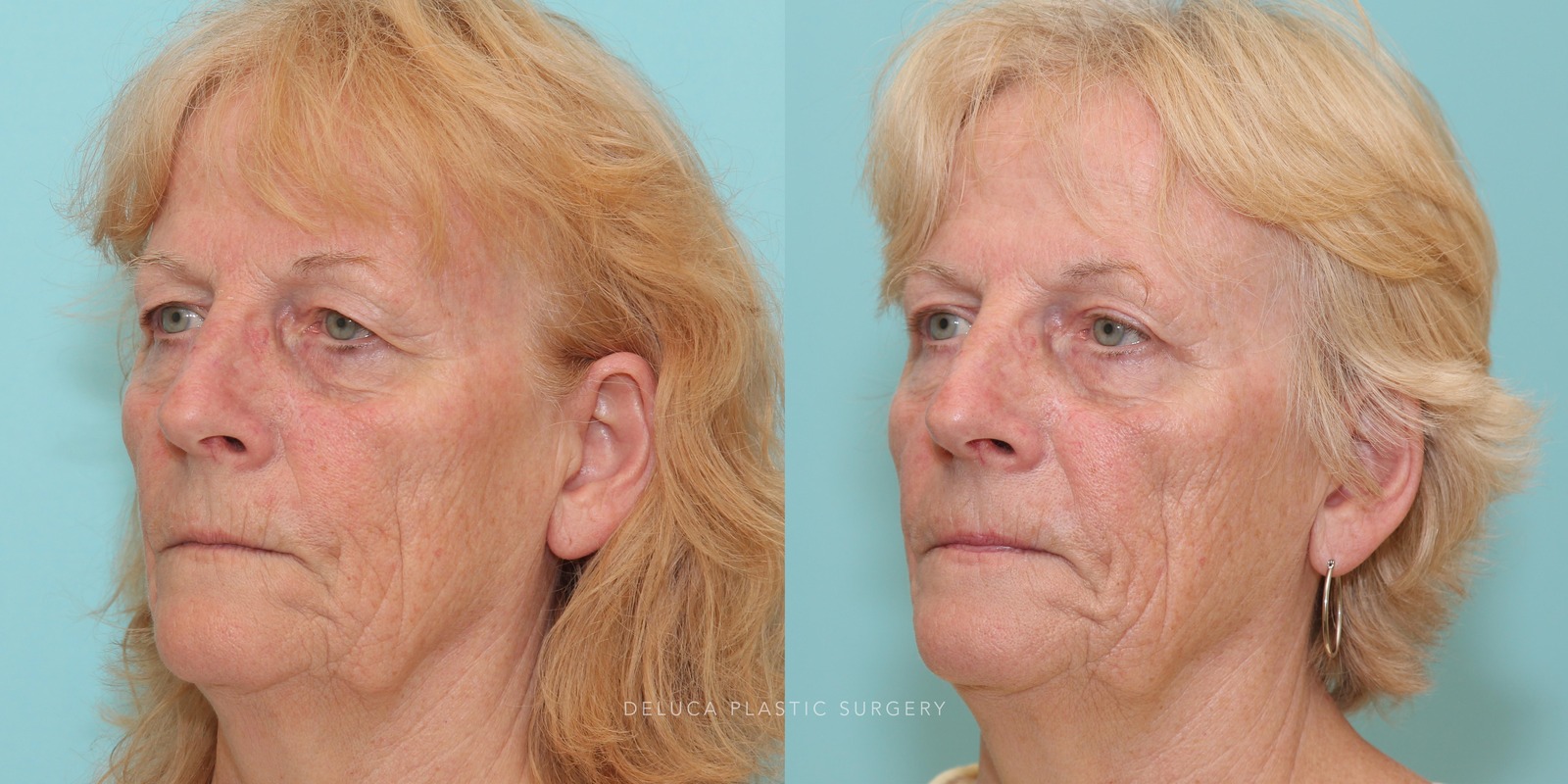 69 year old Upper Eyelid Blepharoplasty