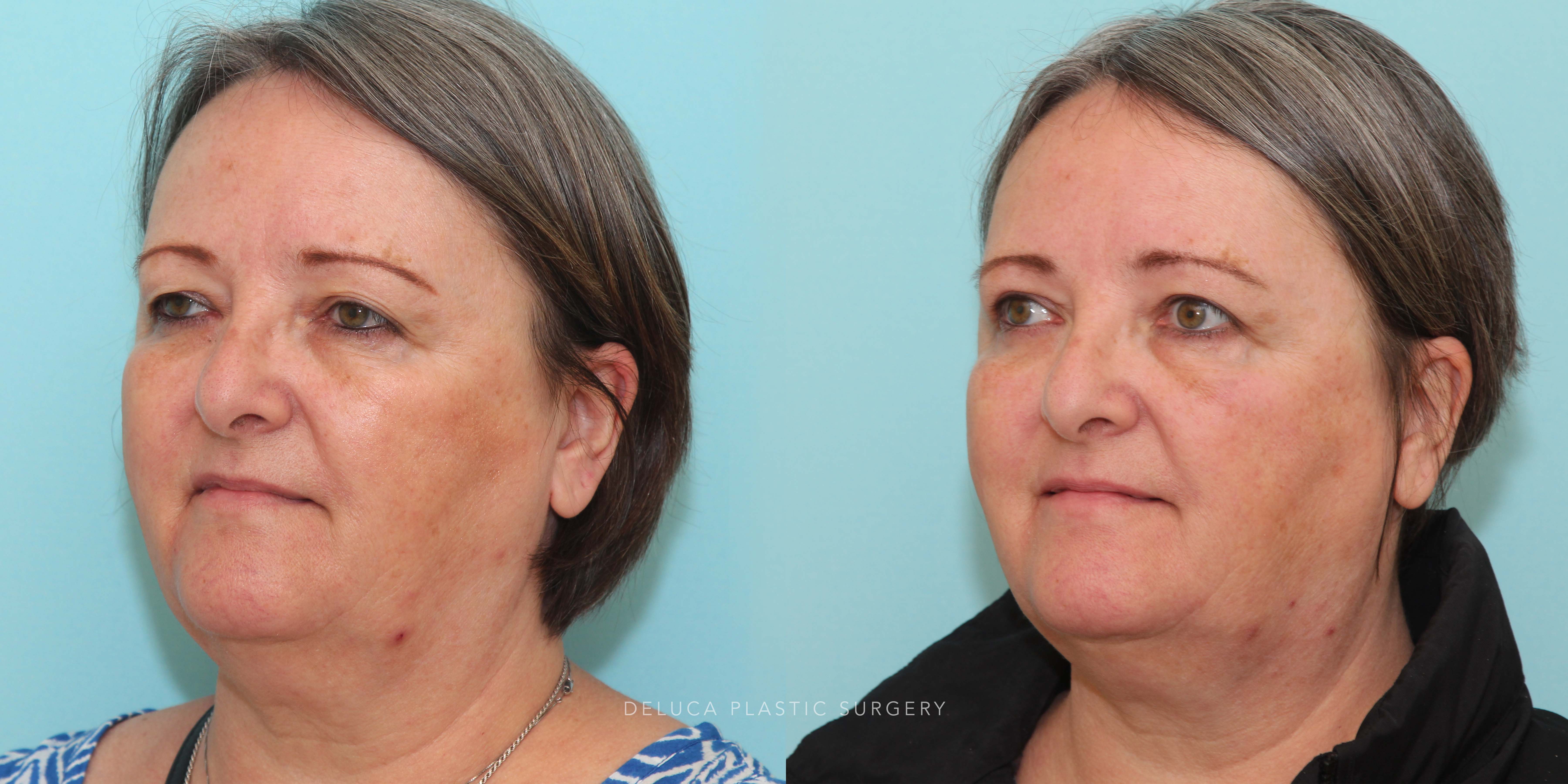 63 year old Upper Lid Blepharoplasty